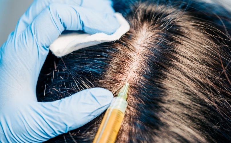 Kadınlara Saç Ekimi Nasıl Yapılır?