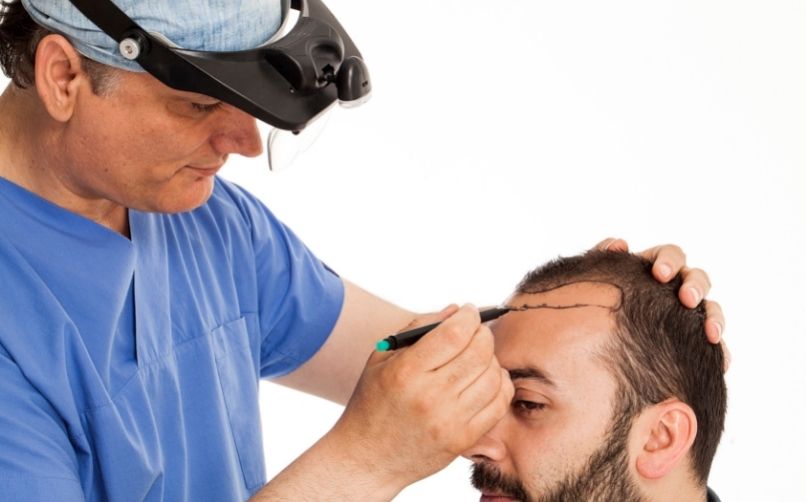 Saç ekimi nedir, nasıl yapılır