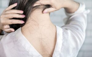 Saç Dökülmesi Tipleri ve Çözümleri Nelerdir?