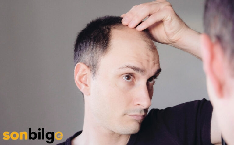 Erkek Tipi Saç Dökülmesi (AGA) Nedenleri ve Çözümleri