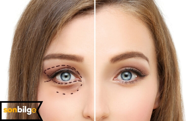 Göz Kapağı Düşüklüğü (Blefaroplasti) Neden Olur?